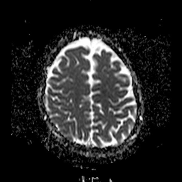 File:Cerebral tuberculoma (Radiopaedia 41152-43932 Axial ADC 19).jpg