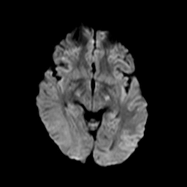 File:Cerebral tuberculoma (Radiopaedia 41152-43932 Axial DWI 9).jpg