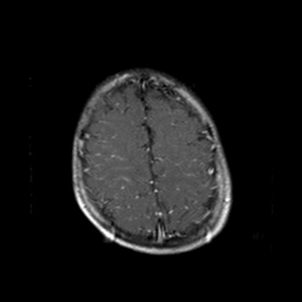 File:Cerebral tuberculoma (Radiopaedia 41152-43932 Axial T1 C+ 19).jpg
