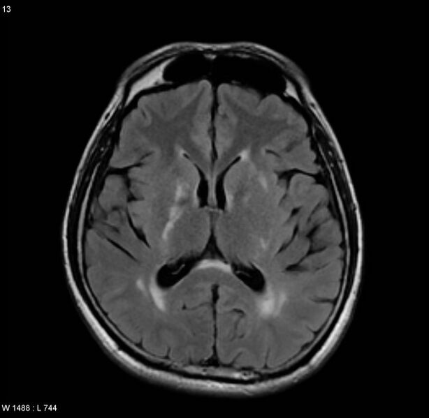 File:Cerebral vasculitis (Radiopaedia 5131-6923 Axial FLAIR 6).jpg