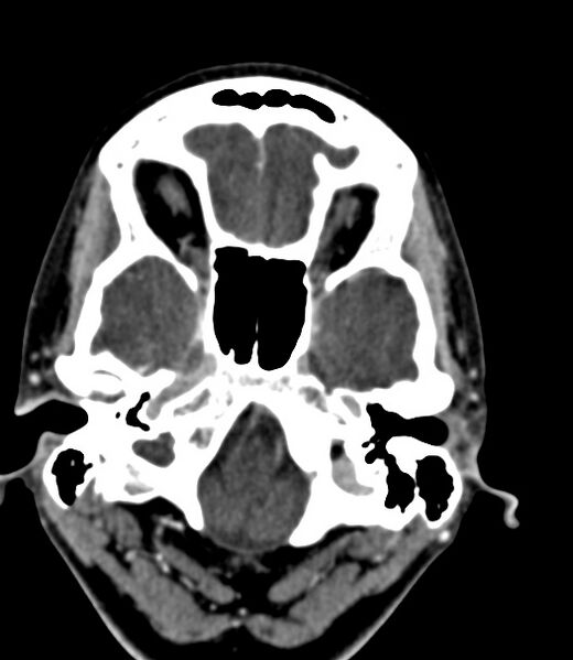 File:Cerebral venous sinus thrombosis (Radiopaedia 59224-66646 Axial C+ delayed 43).jpg