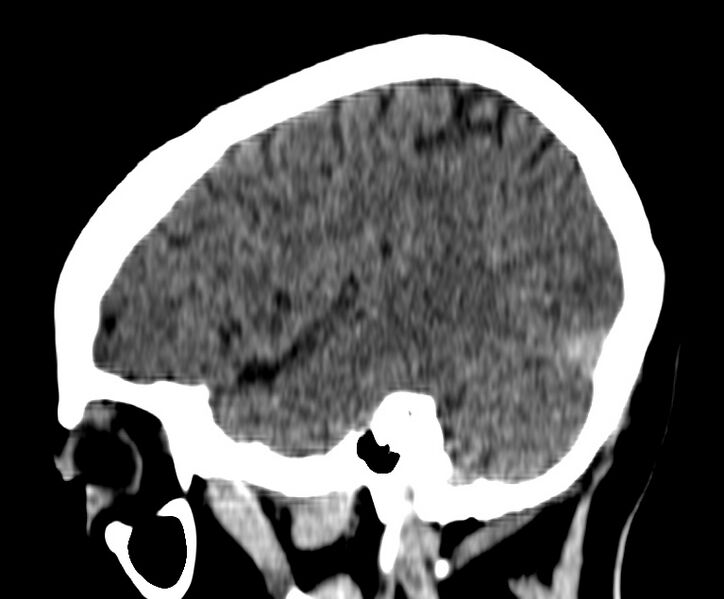 File:Cerebral venous thrombosis - CT only (Radiopaedia 41031-43778 B 34).jpg