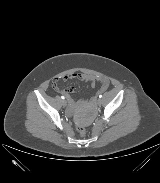 File:Cervical aortic arch with coarctation and aneurysms (Radiopaedia 44035-47552 B 75).jpg
