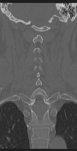 File:Cervical canal stenosis due to ossification of the posterior longitudinal ligament (Radiopaedia 47260-51823 Coronal bone window 41).png