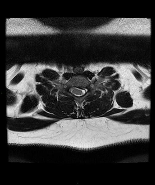 File:Cervical disc prolapse (Radiopaedia 80258-93598 Axial T2 63).jpg