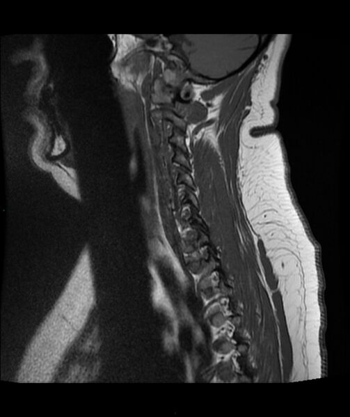 File:Cervical disc prolapse (Radiopaedia 80258-93598 Sagittal T1 3).jpg
