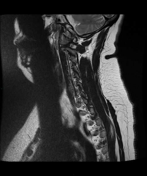 File:Cervical disc prolapse (Radiopaedia 80258-93598 Sagittal T2 13).jpg