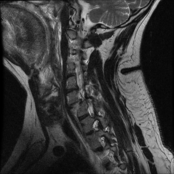 File:Cervical fracture and dislocation with locked facet (Radiopaedia 31837-32781 Sagittal T2 4).jpg