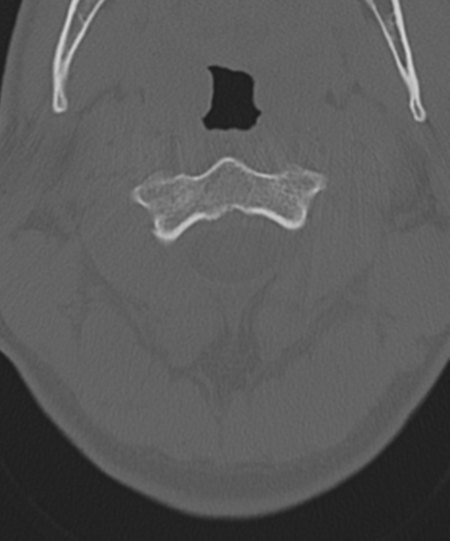 File:Cervical intercalary bone (Radiopaedia 35211-36748 Axial bone window 18).png