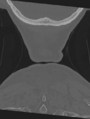 Cervical spondylolysis (Radiopaedia 49616-54811 Coronal bone window 65).png
