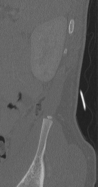 File:Chance fracture (Radiopaedia 40360-42912 Sagittal bone window 4).png