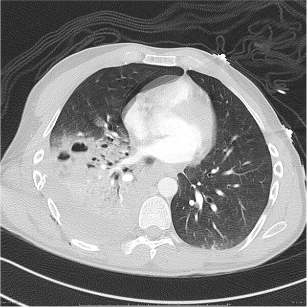 File:Chest and abdomen multi-trauma (Radiopaedia 26294-26425 lung window 65).jpg