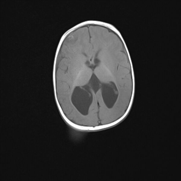 File:Chiari III malformation with occipital encephalocele (Radiopaedia 79446-92559 Axial T1 16).jpg