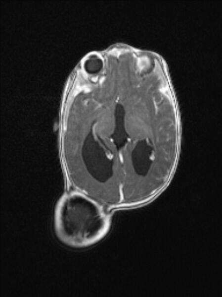 File:Chiari III malformation with occipital encephalocele (Radiopaedia 79446-92559 Axial T1 C+ mpr 48).jpg