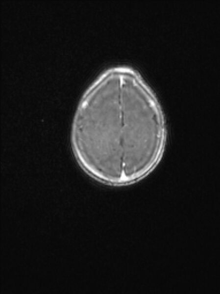 File:Chiari III malformation with occipital encephalocele (Radiopaedia 79446-92559 Axial T1 C+ mpr 72).jpg
