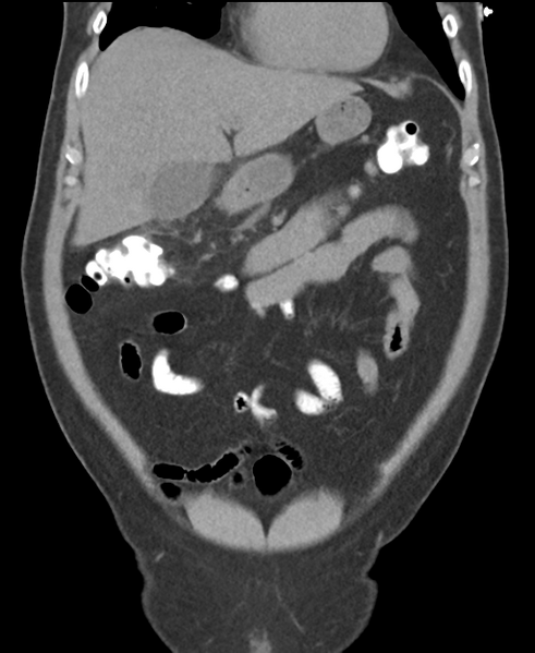File:Cholecystitis with focal perforation and hepatic abscess (Radiopaedia 37189-38945 Coronal non-contrast 17).png