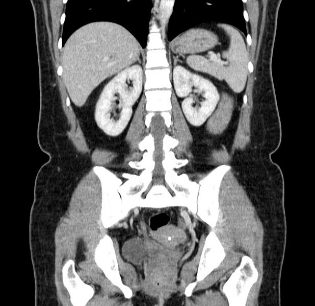 File:Choledocholithiasis on CT and MRI (Radiopaedia 24825-25087 C 34).jpg