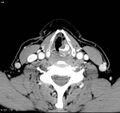 Chondrosarcoma - larynx (Radiopaedia 4588-6698 A 5).jpg