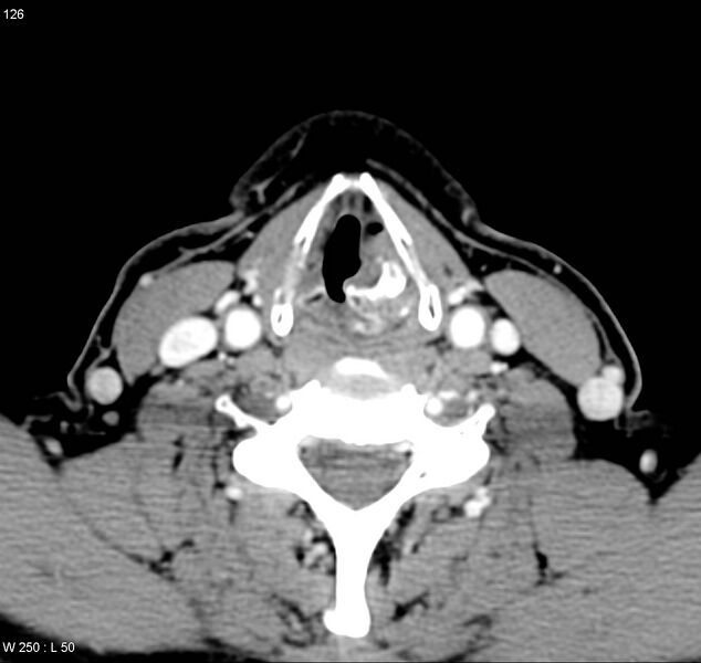 File:Chondrosarcoma - larynx (Radiopaedia 4588-6698 A 5).jpg