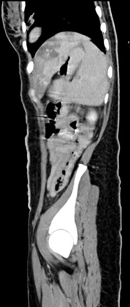 File:Choriocarcinoma liver metastases (Radiopaedia 74768-85766 C 58).jpg