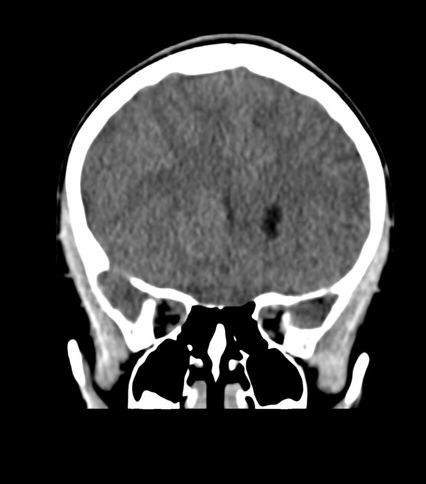 Choroid plexus carcinoma (Radiopaedia 91013-108552 Coronal non-contrast 27).jpg