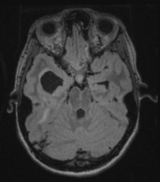 File:Choroid plexus carcinoma (Radiopaedia 91013-108553 Axial FLAIR C+ 108).jpg