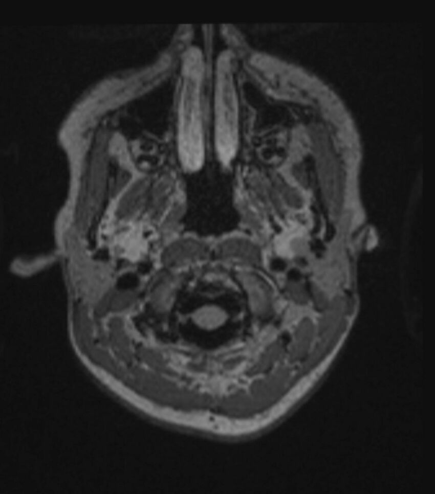 Choroid plexus carcinoma (Radiopaedia 91013-108553 Axial FLAIR C+ 67).jpg