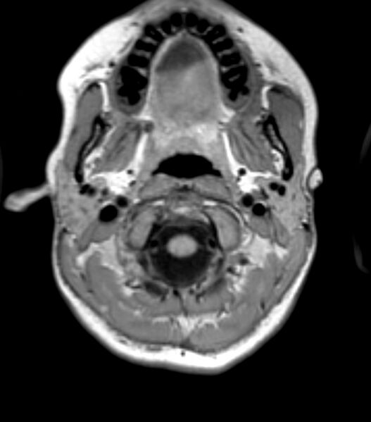 File:Choroid plexus carcinoma (Radiopaedia 91013-108553 Axial T1 24).jpg
