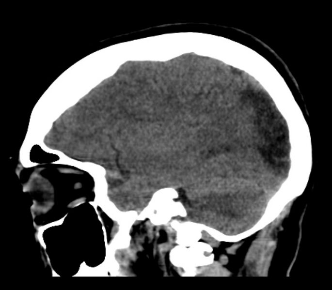 File:Chronic bilateral occipital lobe infarcts (Radiopaedia 31276-31996 C 28).jpg