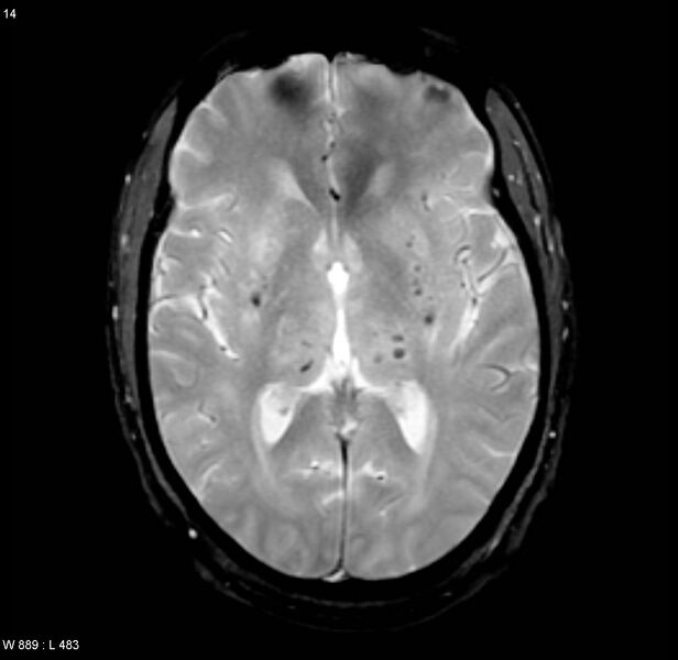 File:Chronic hypertensive encephalopathy (Radiopaedia 4564-6686 Axial Gradient Echo 9).jpg