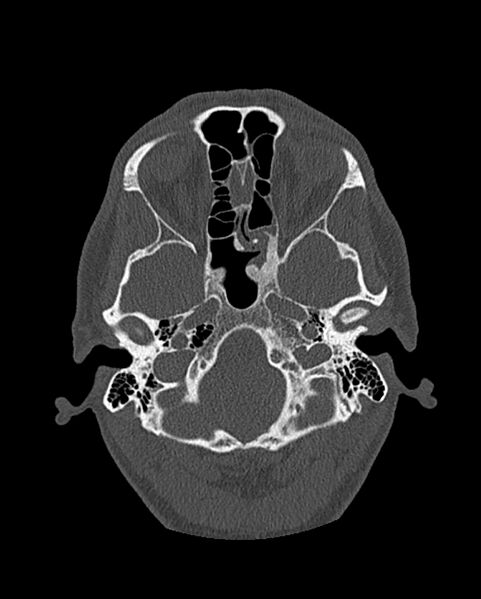 File:Chronic maxillary sinusitis caused by a foreign body (Radiopaedia 58521-65676 Axial bone window 219).jpg