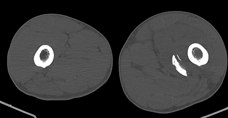 File:Chronic osteomyelitis (with sequestrum) (Radiopaedia 74813-85822 Axial non-contrast 77).jpg