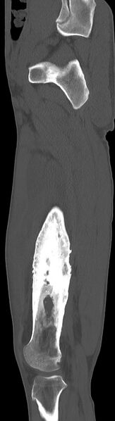 File:Chronic osteomyelitis (with sequestrum) (Radiopaedia 74813-85822 C 75).jpg
