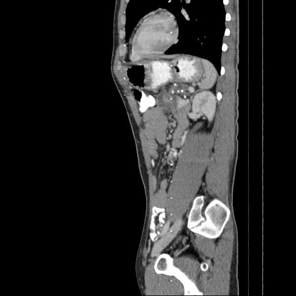 File:Chronic pancreatitis (Radiopaedia 21022-20949 D 7).jpg