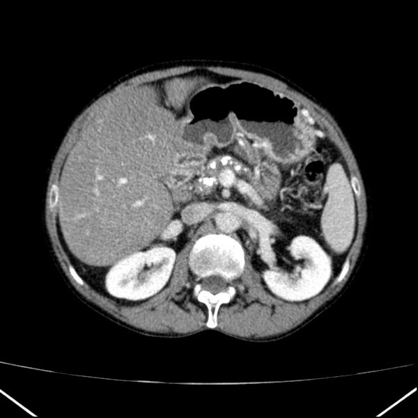 File:Chronic pancreatitis (Radiopaedia 23132-23172 B 21).jpg
