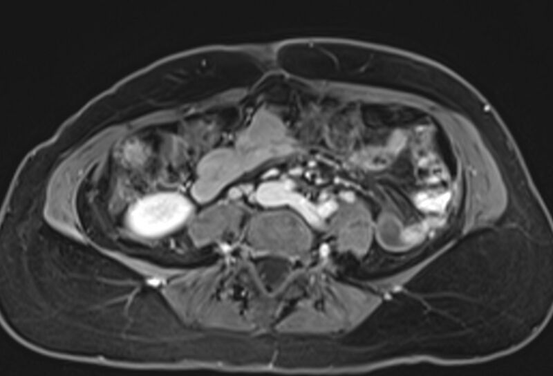 File:Chronic pancreatitis - pancreatic duct calculi (Radiopaedia 71818-82250 Axial T1 C+ fat sat 55).jpg
