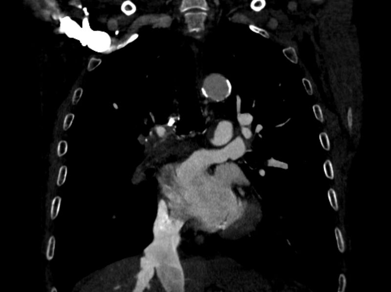 File:Chronic pulmonary embolism (Radiopaedia 91241-108843 A 55).jpg