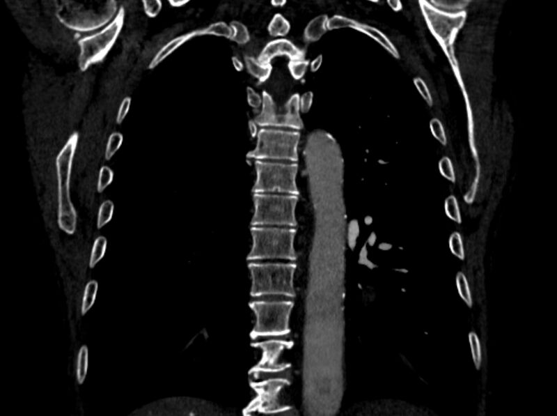 File:Chronic pulmonary embolism (Radiopaedia 91241-108843 A 80).jpg