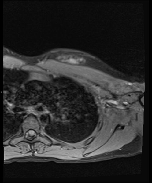 File:Chronic reactive multifocal osteomyelitis (CRMO) - clavicle (Radiopaedia 56406-63114 Axial T1 fat sat 20).jpg
