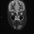 Chronic reactive multifocal osteomyelitis (CRMO) - mandible (Radiopaedia 56405-63069 Coronal STIR 10).jpg
