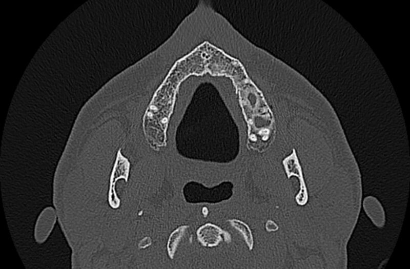 File:Chronic rhinosinusitis (Radiopaedia 65079-74075 Axial bone window 2).jpg