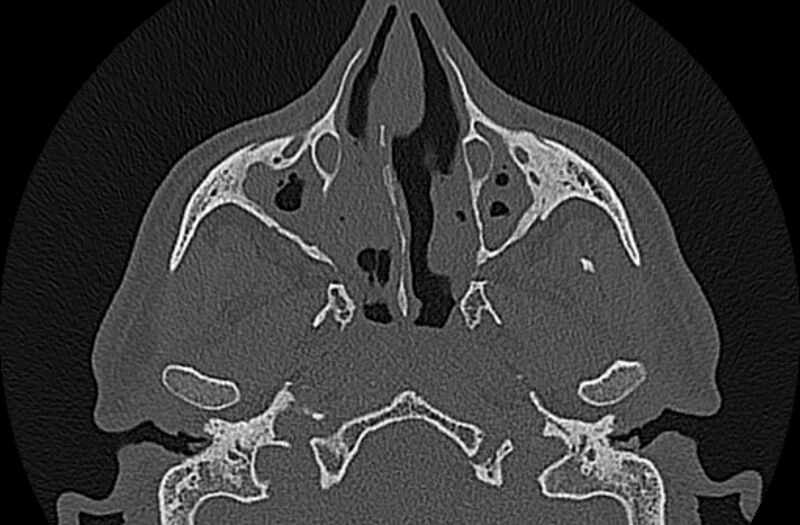File:Chronic rhinosinusitis (Radiopaedia 65079-74075 Axial bone window 29).jpg