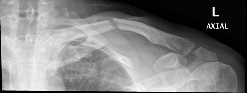 File:Clavicle and rib fractures (Radiopaedia 34975-36475 Frontal Angled up 1).png