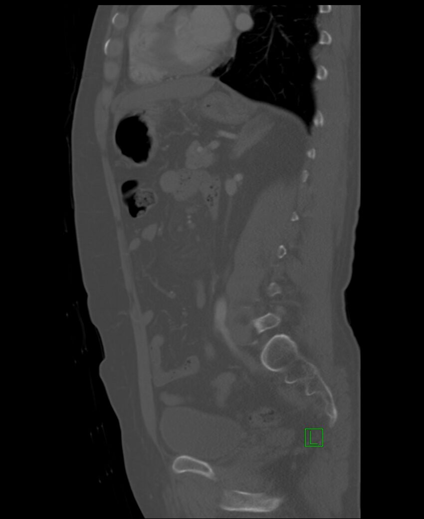 Clear cell renal cell carcinoma (Radiopaedia 85006-100539 Sagittal bone window 24).jpg