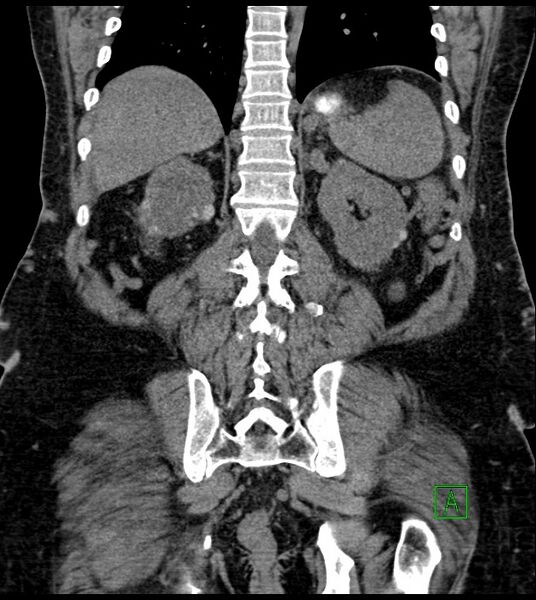 File:Closed-loop small bowel obstruction-internal hernia (Radiopaedia 78439-91096 Coronal non-contrast 76).jpg
