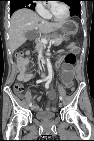 File:Closed loop bowel obstruction and ischemia (Radiopaedia 86959-103180 B 18).jpg