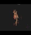 Coarctation of the aorta (Radiopaedia 43373-46729 3D reconstruction 20).jpg