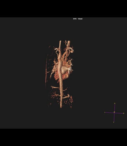 File:Coarctation of the aorta (Radiopaedia 43373-46729 3D reconstruction 6).jpg