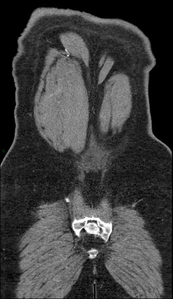 File:Coarctation of the aorta (Radiopaedia 74632-88521 B 247).jpg