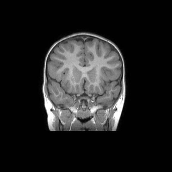 File:Cochlear nerve aplasia - unilateral (Radiopaedia 87910-104413 Coronal T1 19).jpg